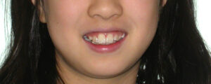 横浜市青葉区歯を抜かない矯正歯科松永デンタルクリニック子供の矯正治療前笑顔画像12