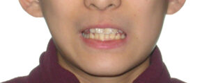 横浜市青葉区歯を抜かない矯正歯科松永デンタルクリニック中学生の矯正治療前笑顔画像25