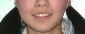 横浜市青葉区歯を抜かない矯正歯科松永デンタルクリニック中学生の矯正治療前笑顔画像24