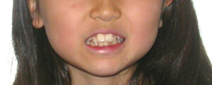 横浜市青葉区歯を抜かない矯正歯科松永デンタルクリニック子供の矯正治療前笑顔画像11