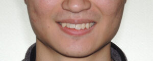 横浜市青葉区矯正歯科松永デンタルクリニック大人の矯正治療前笑顔画像43