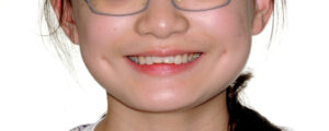 横浜市青葉区歯を抜かない矯正歯科松永デンタルクリニック子供の矯正治療前笑顔画像13
