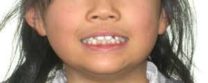 横浜市青葉区歯を抜かない矯正歯科松永デンタルクリニック子供の矯正治療前笑顔画像01