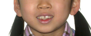 横浜市青葉区歯を抜かない矯正歯科松永デンタルクリニック子供の矯正治療前笑顔画像02