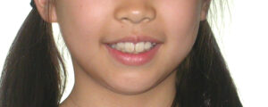 横浜市青葉区歯を抜かない矯正歯科松永デンタルクリニック子供の矯正治療前笑顔画像15