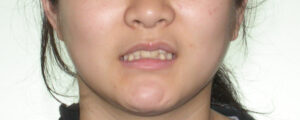 横浜市青葉区歯を抜かない矯正歯科松永デンタルクリニック高校生の矯正治療前笑顔画像32