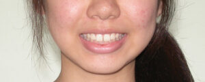 横浜市青葉区歯を抜かない矯正歯科松永デンタルクリニック高校生の矯正治療前笑顔画像33