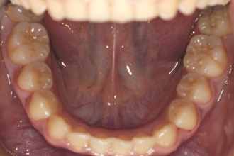 横浜市青葉区歯を抜かない矯正歯科松永デンタルクリニック中学生の矯正治療後下顎画像21