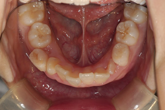 横浜市青葉区歯を抜かない矯正歯科松永デンタルクリニック子供の矯正治療前下顎画像12