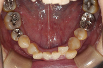 横浜市青葉区矯正歯科松永デンタルクリニック中年の矯正治療前下顎画像53