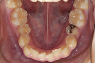 横浜市青葉区歯を抜かない矯正歯科松永デンタルクリニック高校生の矯正治療前下顎画像32