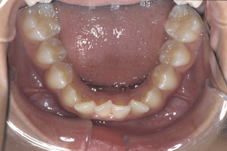 横浜市青葉区歯を抜かない矯正歯科松永デンタルクリニック中学生の矯正治療前下顎画像21