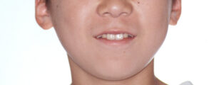 横浜市青葉区歯を抜かない矯正歯科松永デンタルクリニック中学生の矯正治療前笑顔画像26