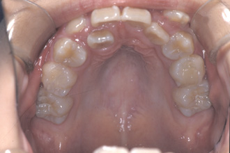 横浜市青葉区歯を抜かない矯正歯科松永デンタルクリニック中学生の矯正治療前上顎画像22
