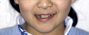 横浜市青葉区歯を抜かない矯正歯科松永デンタルクリニック中学生の矯正治療前笑顔画像22