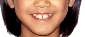 横浜市青葉区歯を抜かない矯正歯科松永デンタルクリニック中学生の矯正治療前笑顔画像21