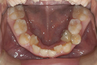 横浜市青葉区歯を抜かない矯正歯科松永デンタルクリニック子供の矯正治療前下顎画像16